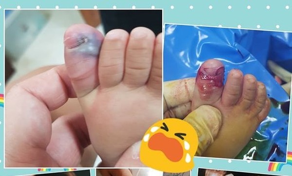 婴儿剪指甲剪伤肉怎么办,给小孩剪指甲剪出血了怎么办