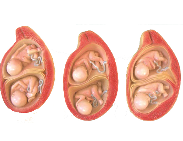 双胎妊娠与单胎妊娠有什么区别？