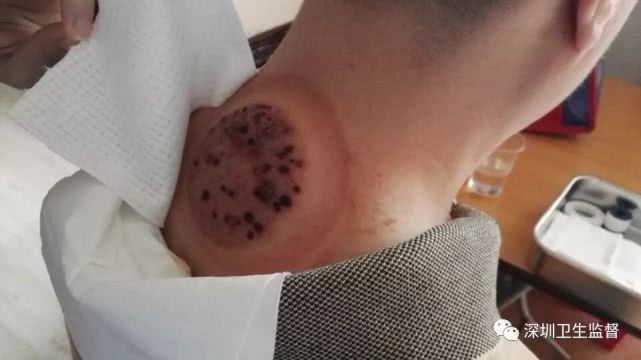 董氏奇穴治脑梗,陕西萨满48穴截根疗法