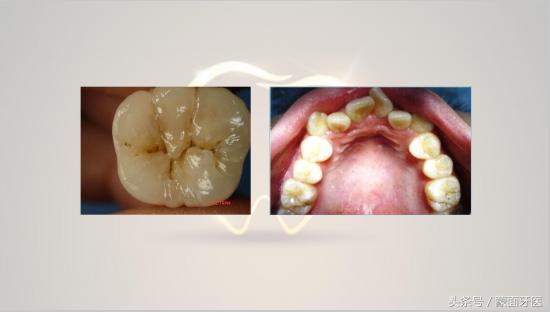 关爱牙齿预防虫牙从小做起,儿童漱口水可以预防虫牙