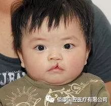 唇腭裂是什么原因造成的,什么原因会导致唇腭裂