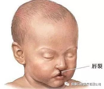 唇腭裂是什么原因造成的,什么原因会导致唇腭裂