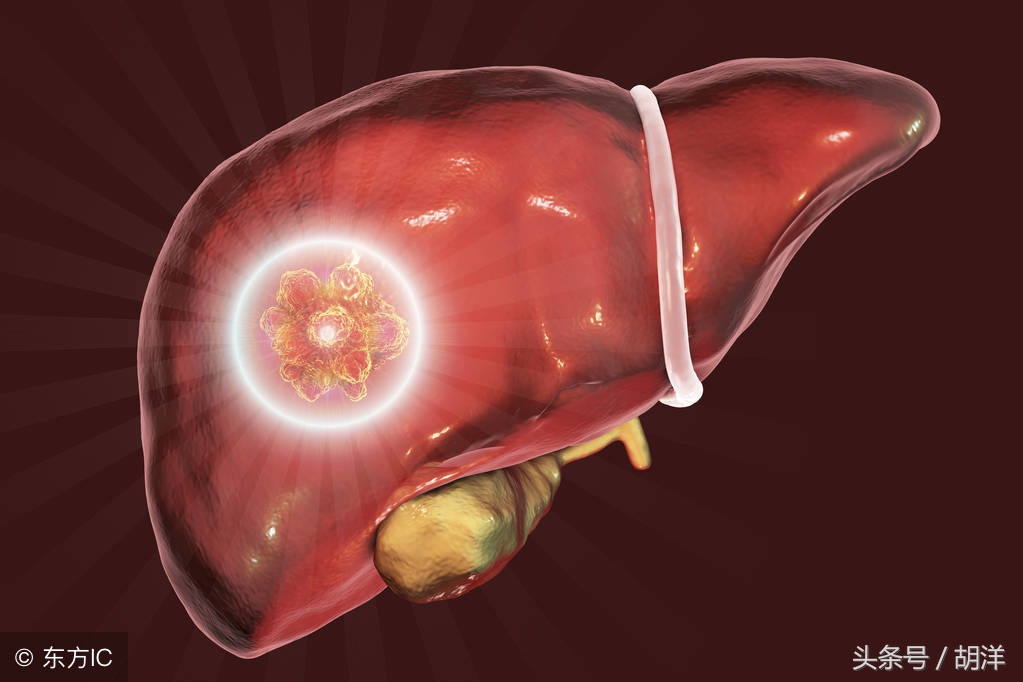 肺癌肝转移患者后期会怎样,肺癌肝转移怎么处理