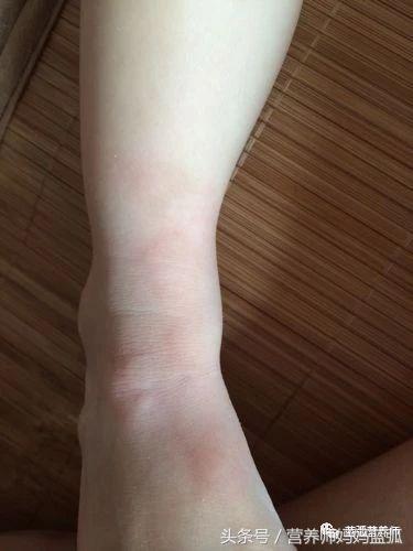 每5个人就有1个患寻麻疹,这样调理才能治本!