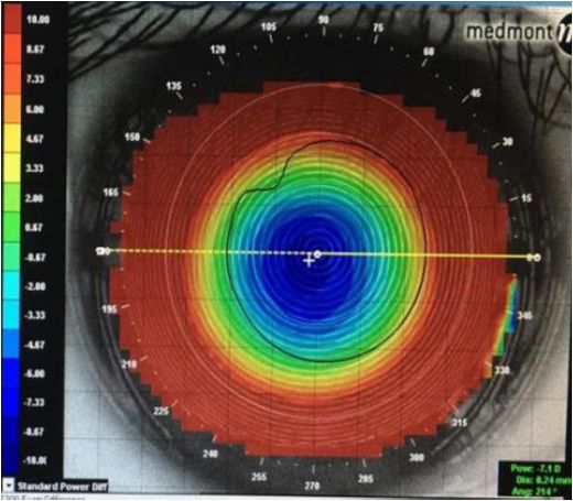 阿托品能治疗多少度近视,阿托品近视防控的注意事项