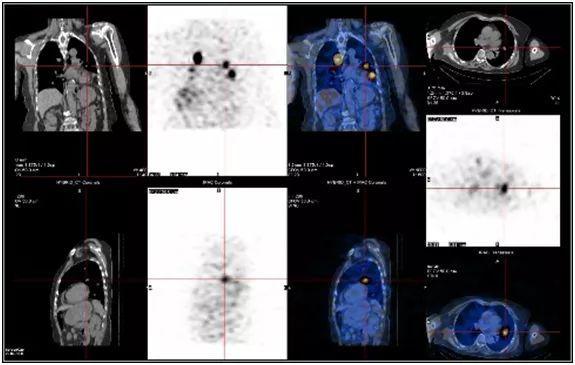 三个方法战胜癌症赶紧学起来,最不容易治愈的十种癌症