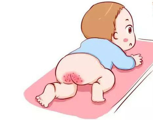 新生宝宝怎么护理不红屁屁,二个月宝宝红屁屁怎么护理