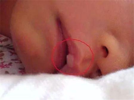 新生婴儿嘴唇上有白色小泡怎么办,新生儿嘴皮起白泡是怎么回事