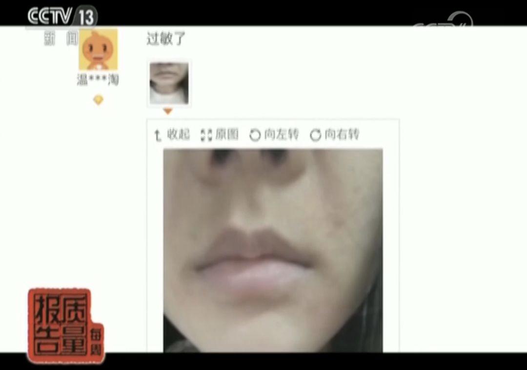 用了八年含激素的面膜会怎么样,面膜导致毁容