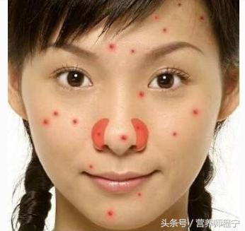 长痘长在鼻子上是什么原因,鼻子两边起痘是怎么回事
