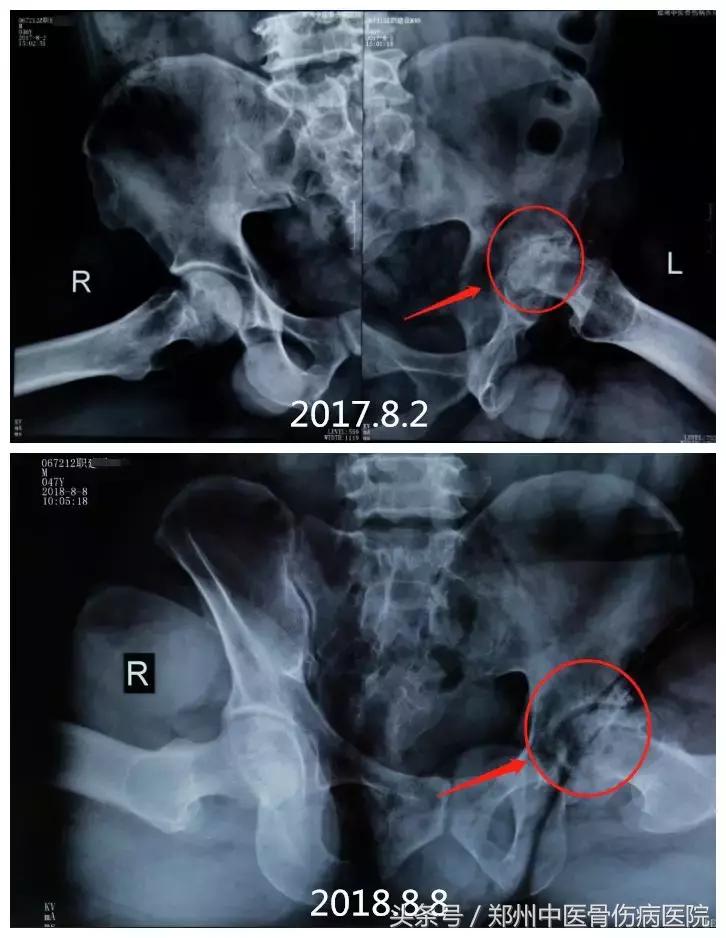 “长短腿”不是腿的问题，到底该如何娇正？答案就在这里