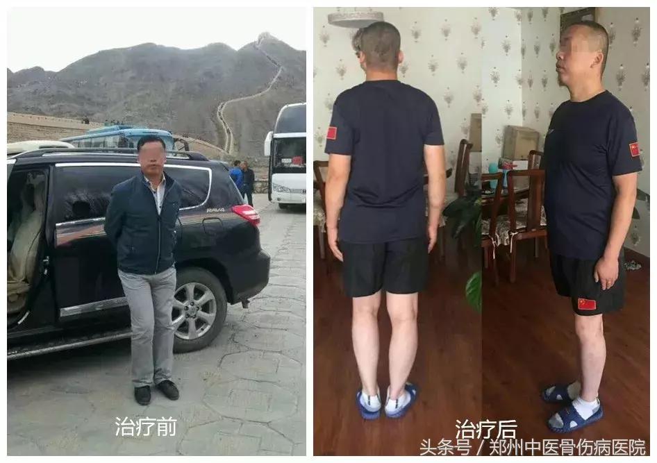 “长短腿”不是腿的问题，到底该如何娇正？答案就在这里