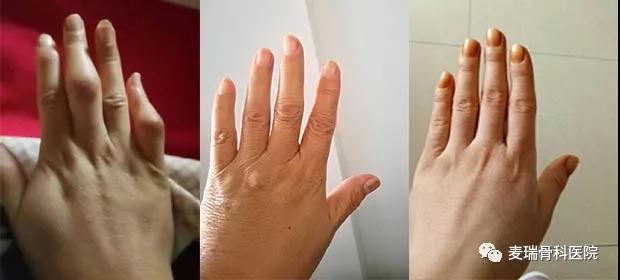 10年老类风湿如何根治,十年老类风湿用什么中成药效果好