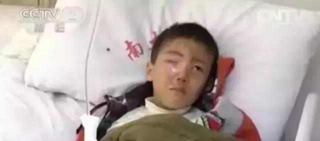 食品干燥剂遇水爆炸伤眼睛图片,误吞干燥剂眼球被溶化