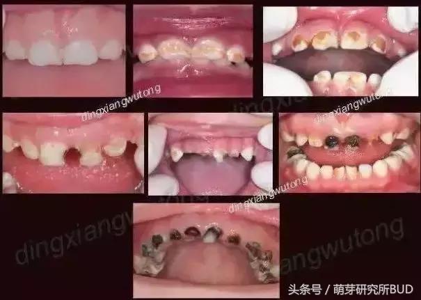 儿童牙齿严重龋齿补救方法,乳牙龋齿怎么治疗最好的方法