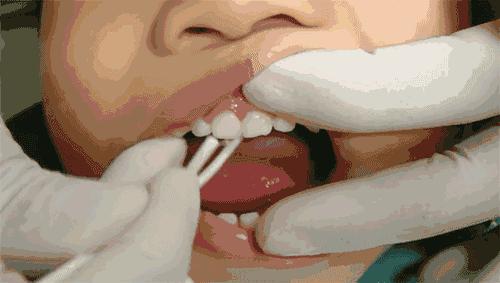 儿童牙齿严重龋齿补救方法,乳牙龋齿怎么治疗最好的方法