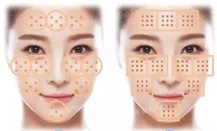 维c、肉毒、prp……水光针成分怎么加？