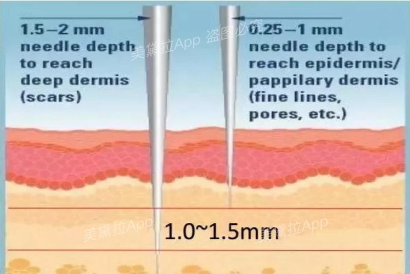 维c、肉毒、prp……水光针成分怎么加？