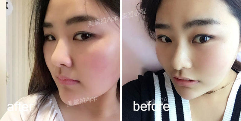 维c、肉毒、prp……水光针成分怎么加？