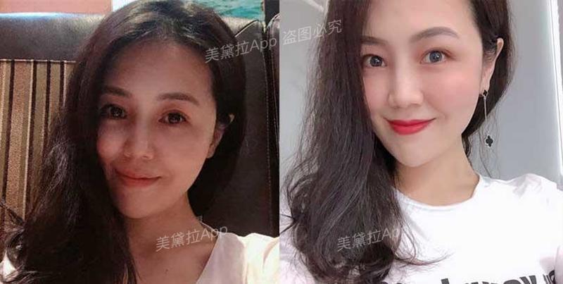 维c、肉毒、prp……水光针成分怎么加？