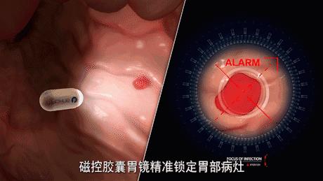 胶囊机器人胃镜可以检查哪些,黑科技胃镜胶囊和普通胃镜