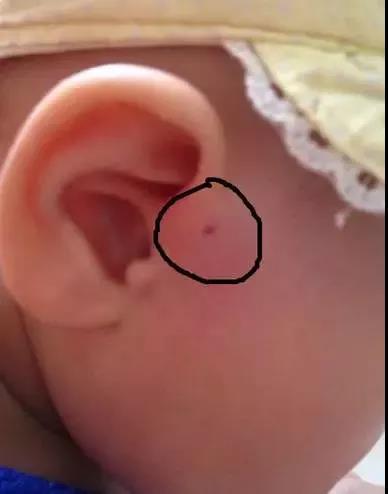 3岁小孩耳朵旁长出聪明孔,孩子耳朵旁边长了个聪明孔
