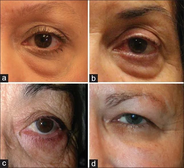 黑眼圈怎么办?如何科学预防黑眼圈?