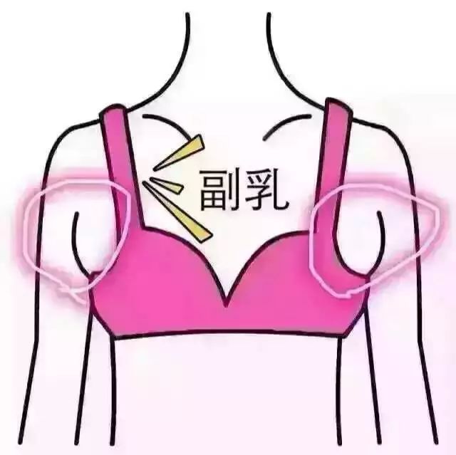 产后副乳怎么消除才正确,产后副乳是什么原因造成的
