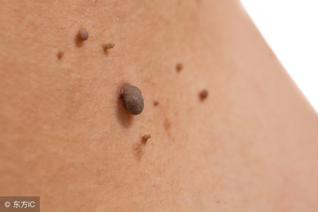 从小就有的痣可能会是黑色素瘤吗,先天性黑素细胞痣恶变的概率大吗