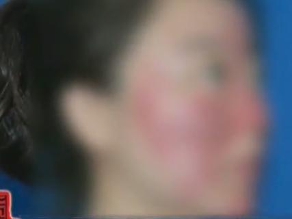 化妆品致面部过敏红肿如何消退,皮肤过敏化妆品是不是不能用了