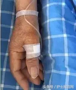 穿刺位置错了怎么处理,穿刺部位应避开什么部位