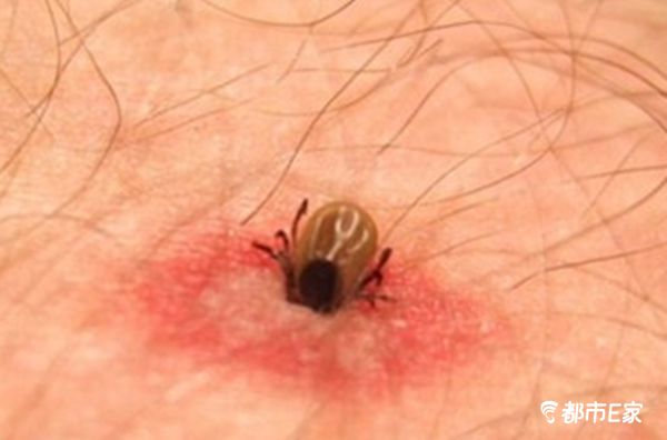 被马蜂蜇了的最快速处理办法,被马蜂蛰的100种方法