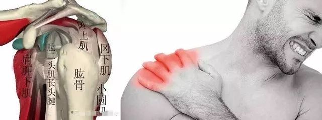 肩峰下撞击综合征影像表现,肩峰撞击综合征推拿治疗