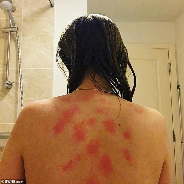 不能洗澡能出汗不,不能洗澡不能出汗的病