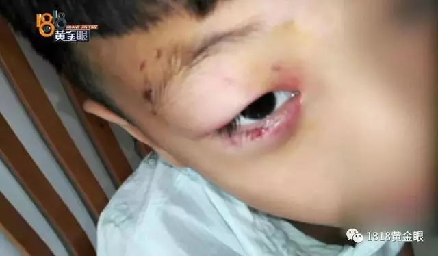 7岁男童被狗咬狂犬病发作死亡,狗咬伤小孩打狂犬疫苗后死亡