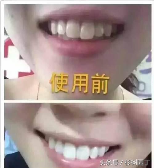 美牙仪是冷光好还是led好,美牙仪真的对牙齿有损伤吗