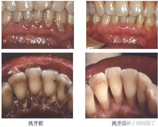 美牙仪是冷光好还是led好,美牙仪真的对牙齿有损伤吗