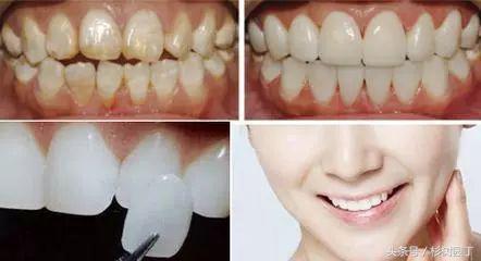 美牙仪是冷光好还是led好,美牙仪真的对牙齿有损伤吗