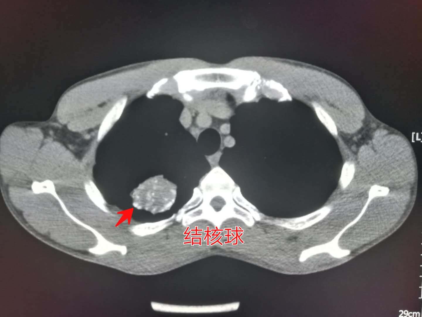 患结核的帅小哥很憋屈:4个月没牵女朋友的手,我现在还传染吗?