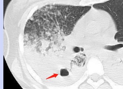 患结核的帅小哥很憋屈:4个月没牵女朋友的手,我现在还传染吗?