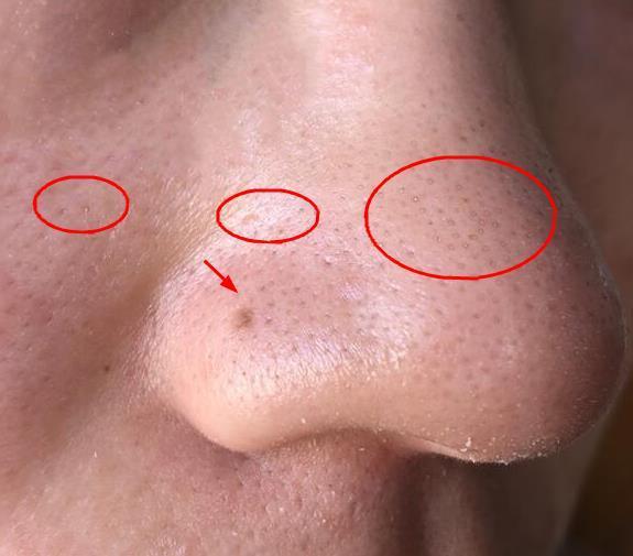 脸上螨虫多毛孔超级大怎么办,脸上螨虫过亿只需一招