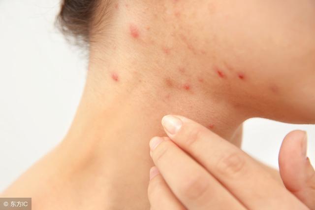 脸上螨虫多毛孔超级大怎么办,脸上螨虫过亿只需一招