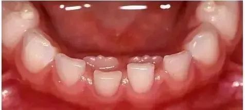 孩子要换牙这6点必须注意,过早换牙的孩子要注意