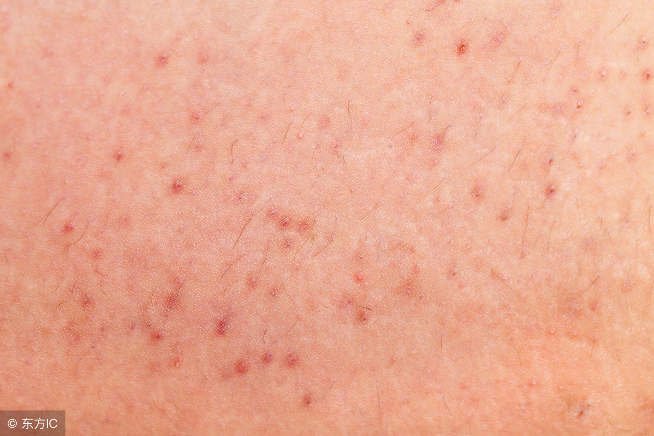毛囊炎形成的疤痕疙瘩怎么治,怎么预防毛囊炎变成疤痕疙瘩