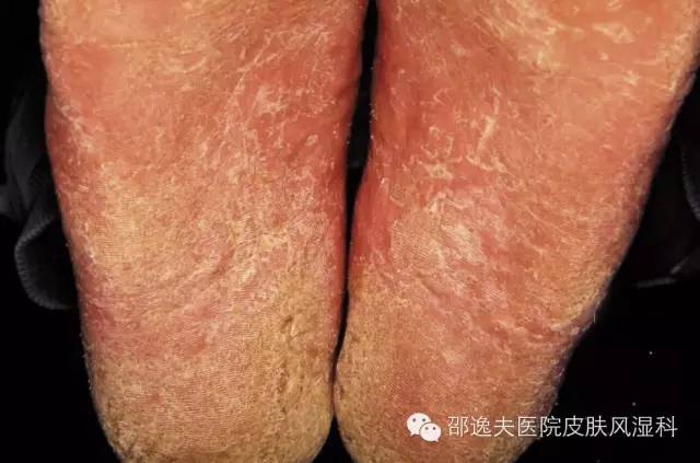 脚气真的不能治吗,脚气真的治不好吗知乎