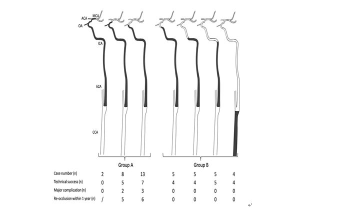 学术快报｜莫大鹏：颈动脉病变的复合手术治疗原则