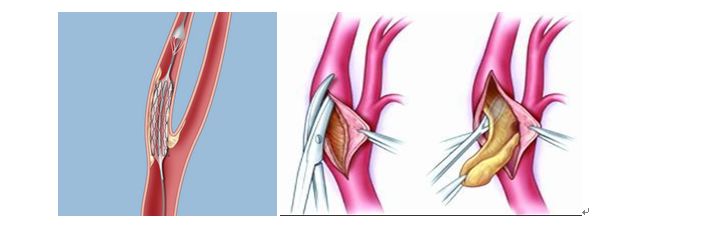 学术快报｜莫大鹏：颈动脉病变的复合手术治疗原则