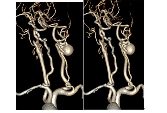 学术快报｜莫大鹏：颈动脉病变的复合手术治疗原则
