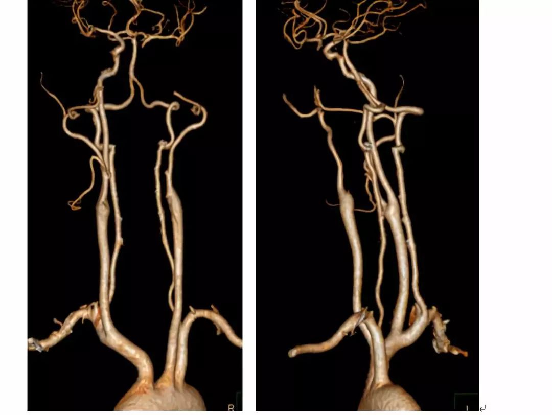 学术快报｜莫大鹏：颈动脉病变的复合手术治疗原则