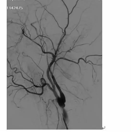 学术快报｜莫大鹏：颈动脉病变的复合手术治疗原则